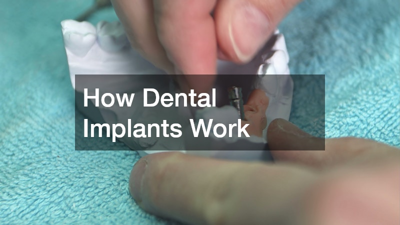 How Dental Implants Work